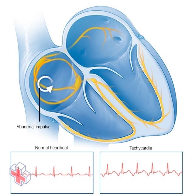Tachycardia heartbeat