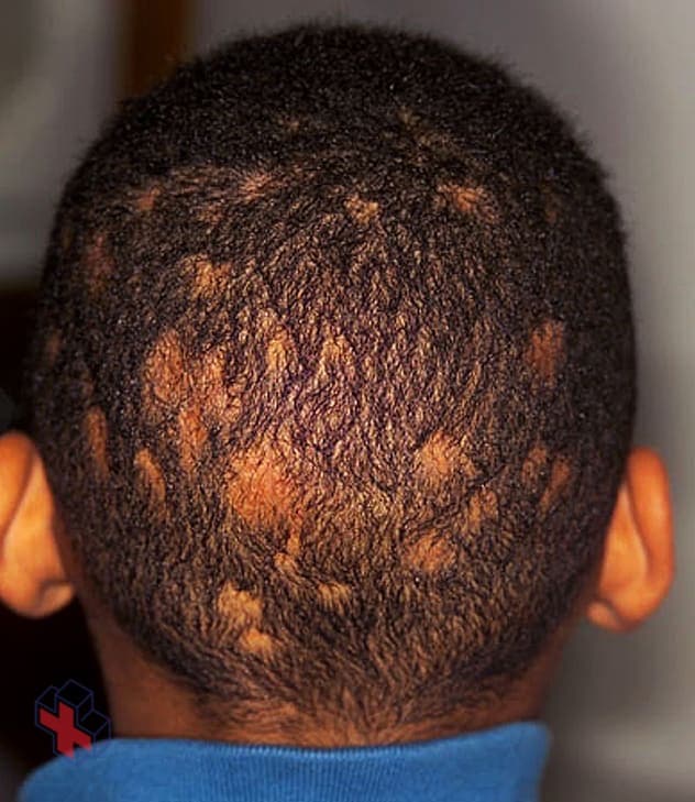 Picture of ringworm of the scalp