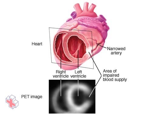 PET scan image of the heart