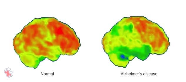 PET scans of the brain for Alzheimer's disease