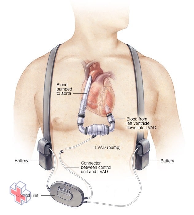 Left ventricular assist device (LVAD)