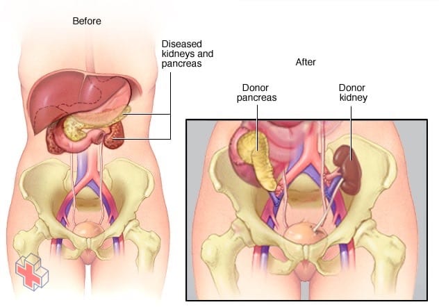 Transplanted pancreas and kidney