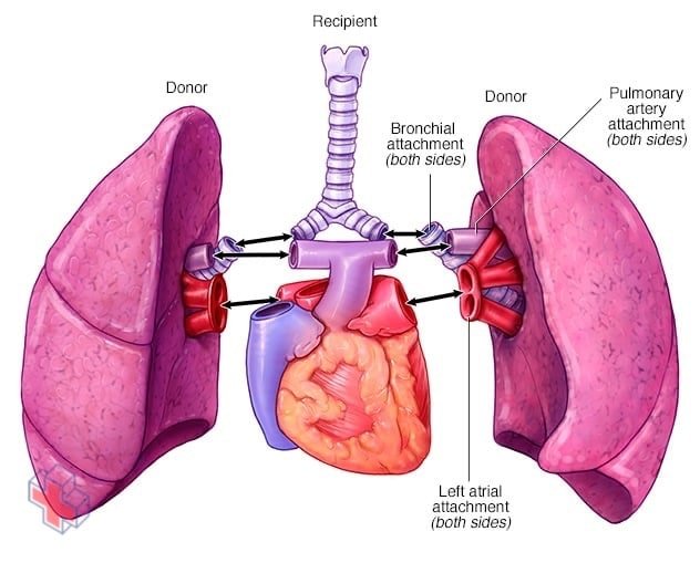 Double-lung transplant