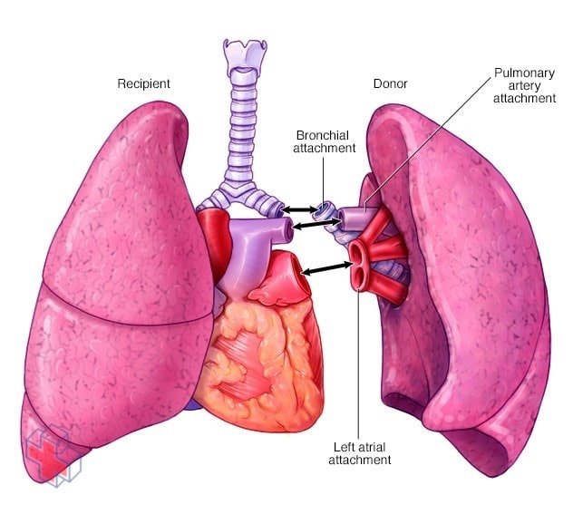 Lung transplant