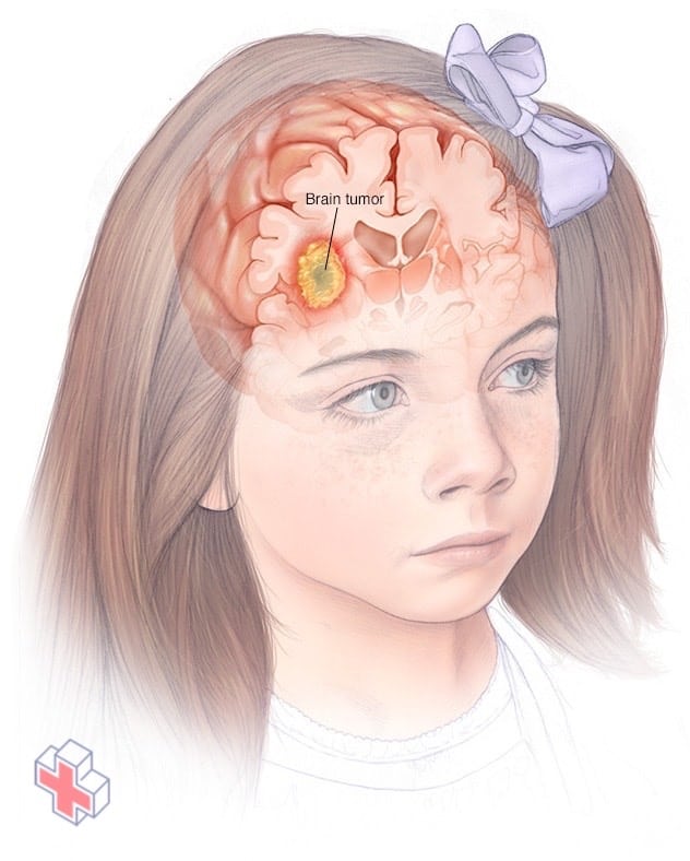 Brain tumor in child