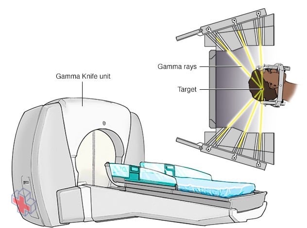 Gamma Knife stereotactic radiosurgery