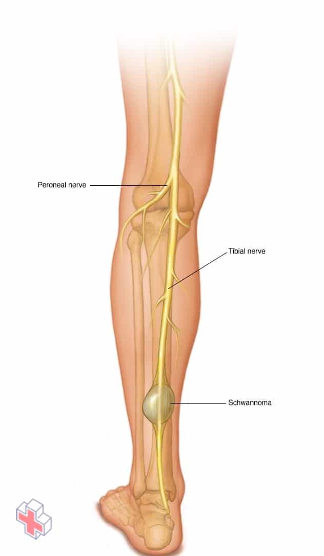 Schwannoma in the leg