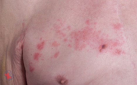 Image of shingles rash